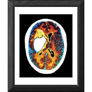 Stroke+ct+scan+images