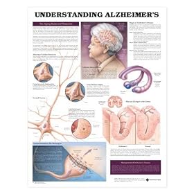 Click here to buy Chart - Understanding Alzheimer's Disease by Lake Forest Anatomicals Brain Models.