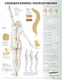 Understanding Osteoporosis Anatomical Chart