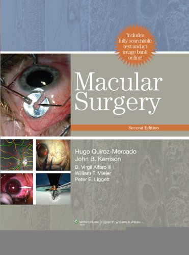 Macular Surgery On Sale