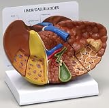 Liver Model Diseased with Cancer