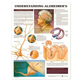 Understanding Alzheimer's Anatomical Chart Laminated