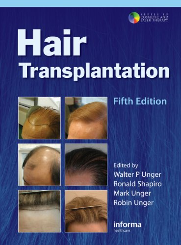 Hair Transplantation (with Procedural DVD), Fifth Edition