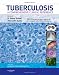 Tuberculosis: A Comprehensive Clinical Reference