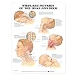 Whiplash Injuries of the Head and Neck Anatomical Chart