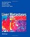 Liver Metastases 51eA8EcifrL. SL75 Laparoscopic Liver Tumor Removal (#3)