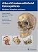 Atlas of Craniomaxillofacial Osteosynthesis: Microplates, Miniplates, and Screws
