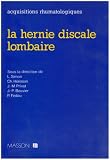 La hernie discale lombaire