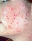 ACNE 101