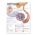 Understanding Type 1 Diabetes Anatomical Chart by Anatomical Chart Company