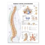 Human Spine Disorders Anatomical Chart