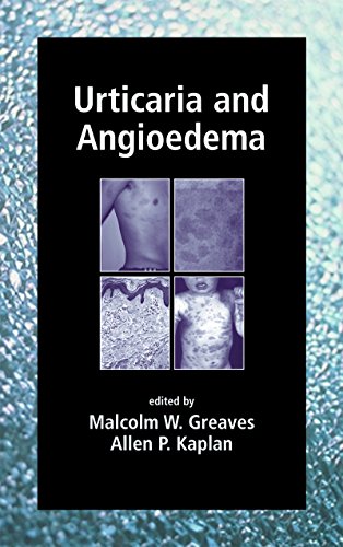 Urticaria and Angioedema