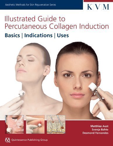 Illustrated Guide to Percutaneous Collagen Induction: Basics, Indications, Uses (Aesthetic Methods for Skin Rejuvenation) by Matthias Aust Published by Quintessence Pub Co 1st (first) edition (2013) Hardcover