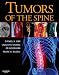 Books : Tumors of the Spine