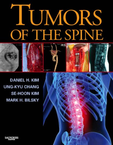 Image of: Tumors of the Spine