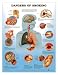 Dangers Of Smoking Anatomical Chart Plastic Styre
