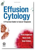 Effusion Cytology: A Practical Guide to Cancer Diagnosis