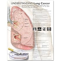 Understanding Lung Cancer Anatomical Chart (Laminated)