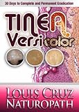Tinea Versicolor - 30 Days to Complete Elimination