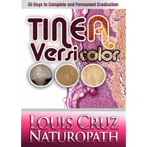 Tinea Versicolor - 30 Days to Complete Elimination