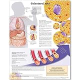 High Cholesterol Anatomical Chart in Spanish (Colesterol alto)