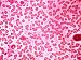 Pernicious Anemia Sample Red Blood Cells Photographic Poster Print, 12x16