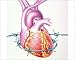 Photographic Print of Heart disease from Science Photo Library