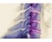 Photographic Print of Bony spurs in neck, X-ray from Science Photo Library