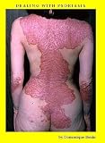 Dealing with Psoriasis