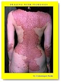 Dealing with Psoriasis