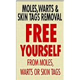 How To Remove Skin Moles, Tags And Warts