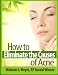 How to Eliminate the Causes of Acne How to Eliminate the Causes of Acne