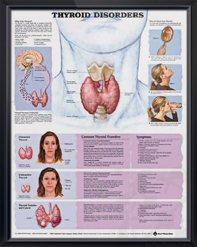 Thyroid Disorders, DeuPair 20x26" Pocket Frame Human Anatomy Poster