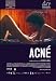 Acne - Movie Poster - 11 x 17