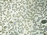 Pernicious Amemia Folic Acid B-12 Deficiency Photographic Poster Print, 16x12