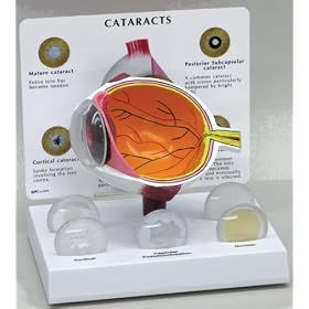 Cataract Eye Model