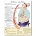 Metabolic Syndrome Anatomical Chart in Spanish (Síndrome metabólico)