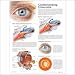 Understanding Glaucoma Anatomical Chart