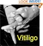 VITILIGO: Symptoms, Causes, Diagnosis and Effective Treatments - Official Guide from the National Institute of Skin Diseases