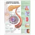 Understanding Type 2 Diabetes Anatomical Chart by  Anatomical Chart Company