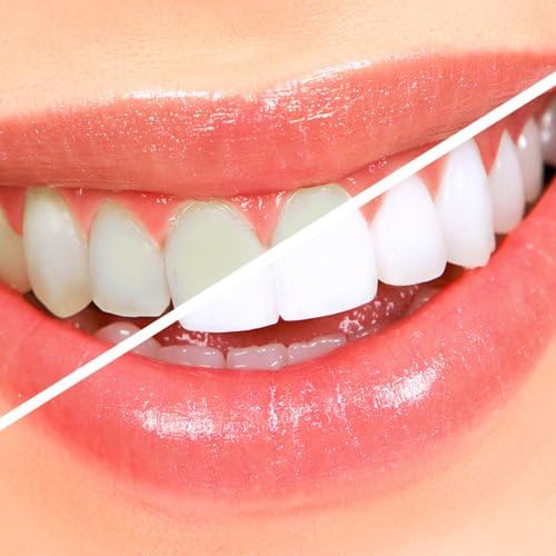 Expertwhite 35% Teeth Whitening Gel - Rapid Results Formula (12-gel pk) - Free 2 day shipping from vendor