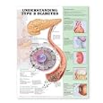 Understanding Type 2 Diabetes Anatomical Chart by Anatomical Chart Company