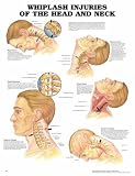 Whiplash Injuries of the Head and Neck Anatomical Chart
