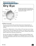 Dry Eye