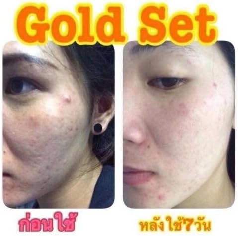 12 Sets X Result Within7days. Freshy Face Gold SET Acne & Blemish Treatments Whitening and Aura Skin.