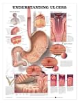 Understanding Ulcers Anatomical Chart