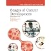 Stages of Cancer Development (The Biology of Cancer)