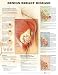 Book Benign Breast Disease Anatomical Chart