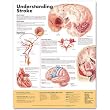 Understanding Stroke Anatomical Chart, 2nd Edition