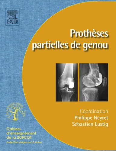 Prothèses partielles du genou: Prothèses unicompartimentaires et fémoropatellaires (French Edition)